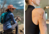 I Was the Pale Girl in High School—Now I’m a Four-Time Melanoma Survivor
